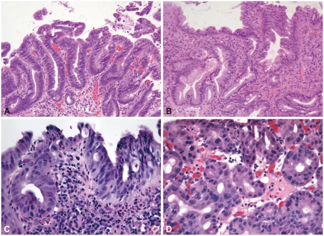 Barrett's Esophagus: Intestinal Metaplasia and Dysplasia