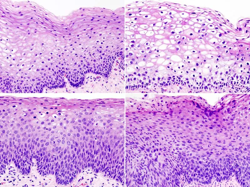 Cervical Intraepithelial Neoplasia (CIN) Grades
