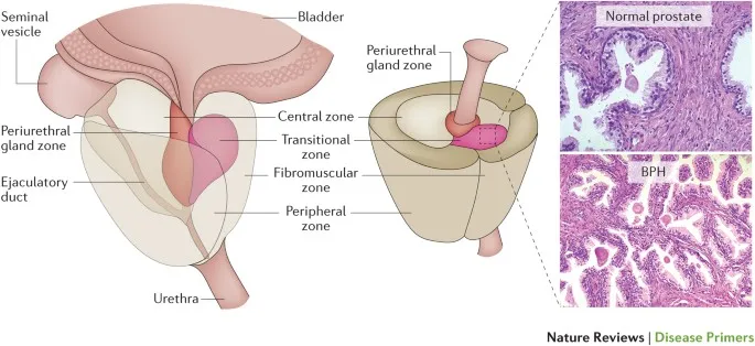 Normal vs. BPH prostate histology and anatomy