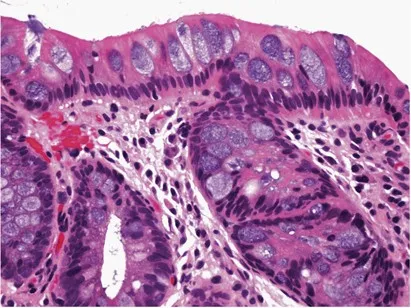 Barrett's Esophagus: Intestinal Metaplasia with Goblet Cells