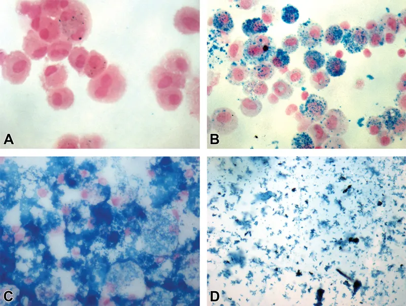 Hemosiderin in alveolar macrophages (Prussian blue stain)
