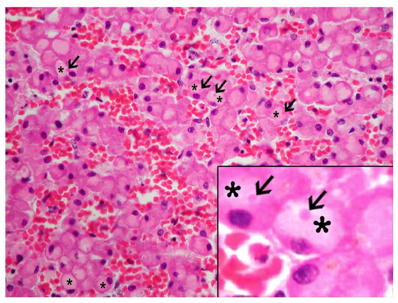 Mallory bodies in hepatocyte histology