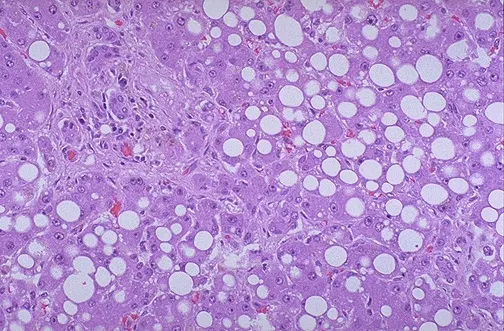 Hepatic Steatosis with Macrovesicular Fat