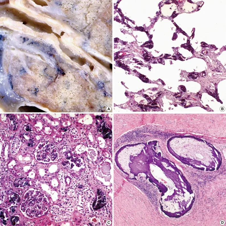 Metastatic calcification in lung, kidney, and stomach