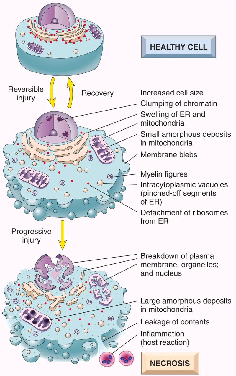 Reversible vs. Irreversible Cell Injury and Necrosis