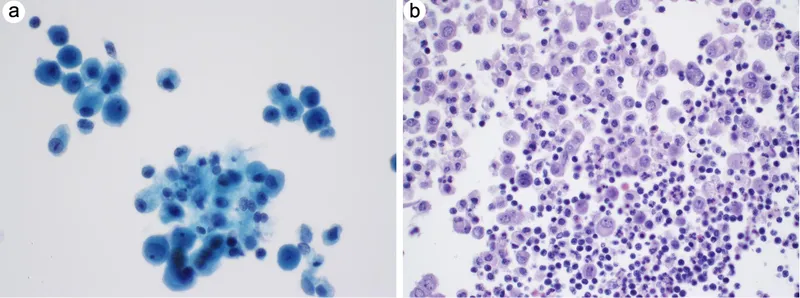 Malignant cells in effusion