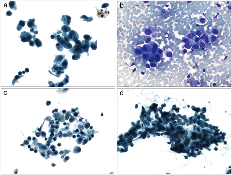 Malignant mesothelioma cells in pleural fluid