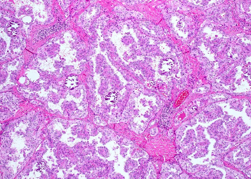 Psammoma bodies in Papillary Thyroid Carcinoma FNAC