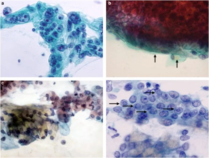 Pancreatic Adenocarcinoma FNA Cytology