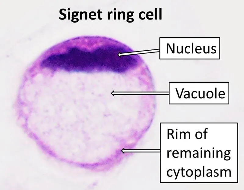 Signet ring vs intestinal type adenocarcinoma