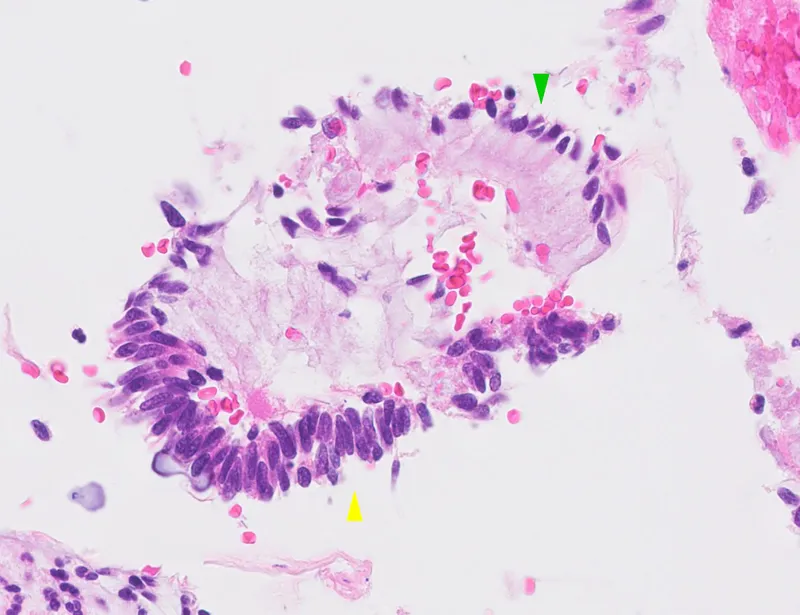 Endocervical adenocarcinoma in situ with feathering