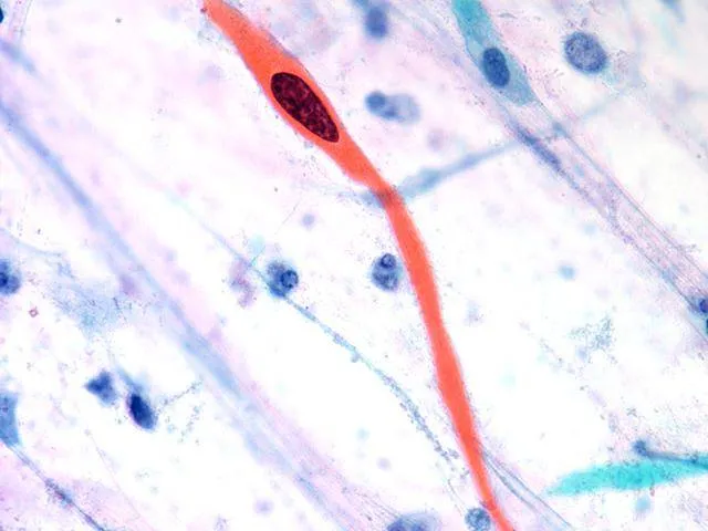 Tadpole cell in keratinizing squamous cell carcinoma