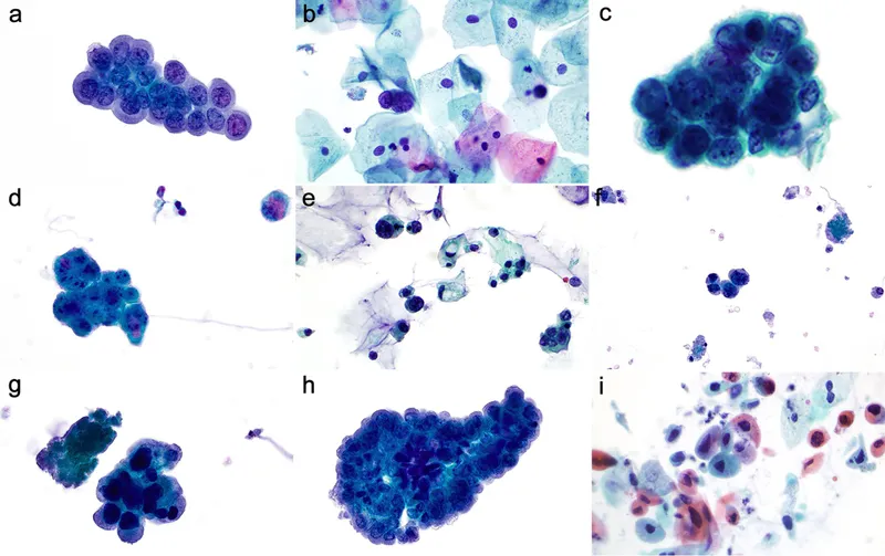 High-Grade Urothelial Carcinoma Cytology Examples