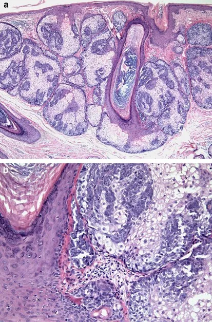 Histopathology of Sebaceous Adenoma