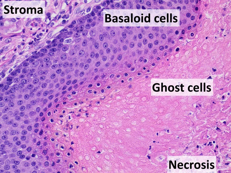 Pilomatricoma histopathology
