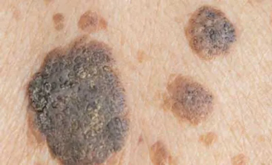 Seborrheic Keratosis: Clinical Presentation