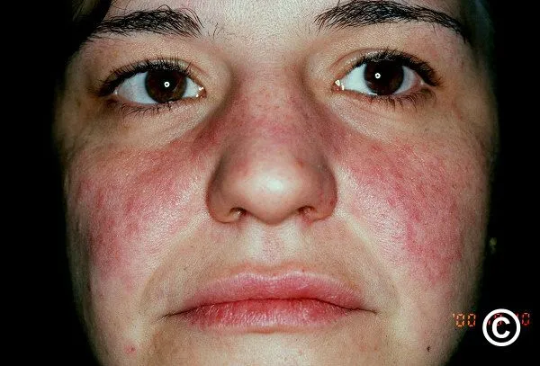 Malar rash in systemic lupus erythematosus