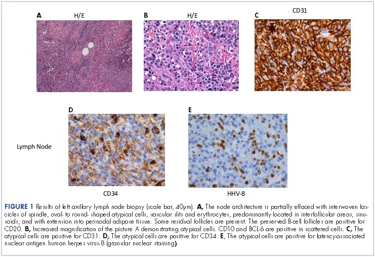 Histopathology of Kaposi Sarcoma in Lymph Node