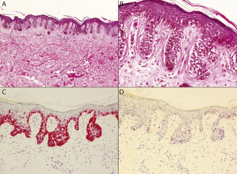 Lentigo Simplex Histology: Melanocytic Hyperplasia