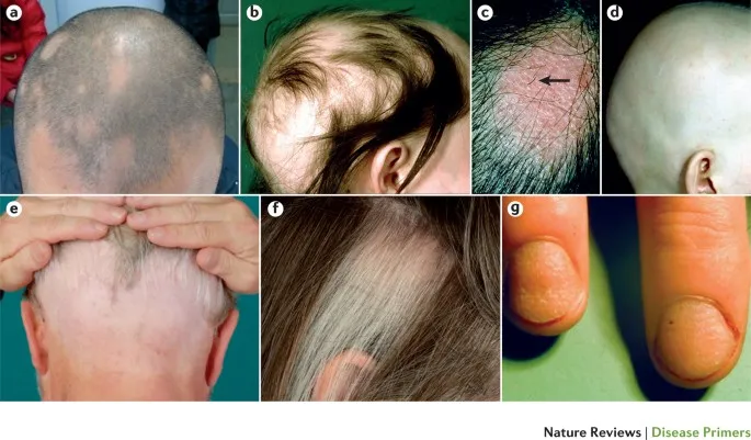 Clinical images of hair and nail disorders