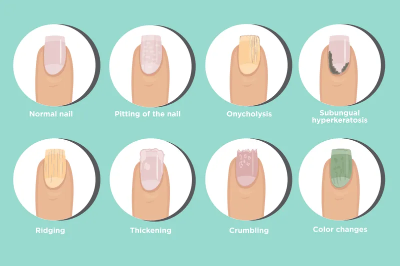 Nail Psoriasis Manifestations