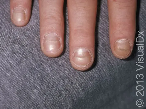 Beau's lines on fingernails