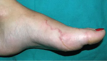 Cutaneous Larva Migrans on Foot