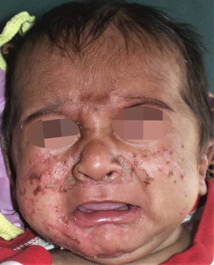 Infant with extensive impetigo on face
