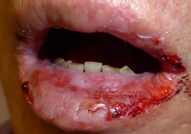 Severe mucosal erosions in Stevens-Johnson syndrome