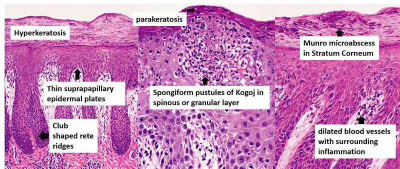 Psoriasis histology with key features labeled
