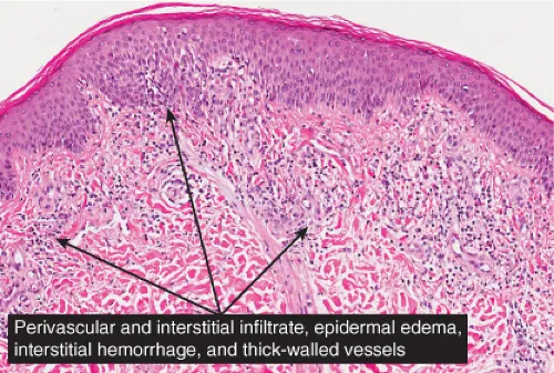 Histopathology of Spongiotic Dermatitis