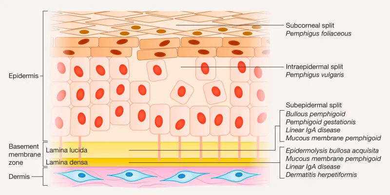Skin split levels in bullous diseases