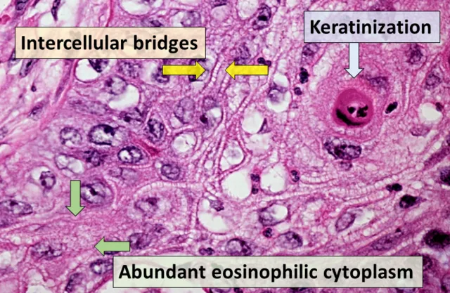 Squamous Cell Carcinoma Histopathology
