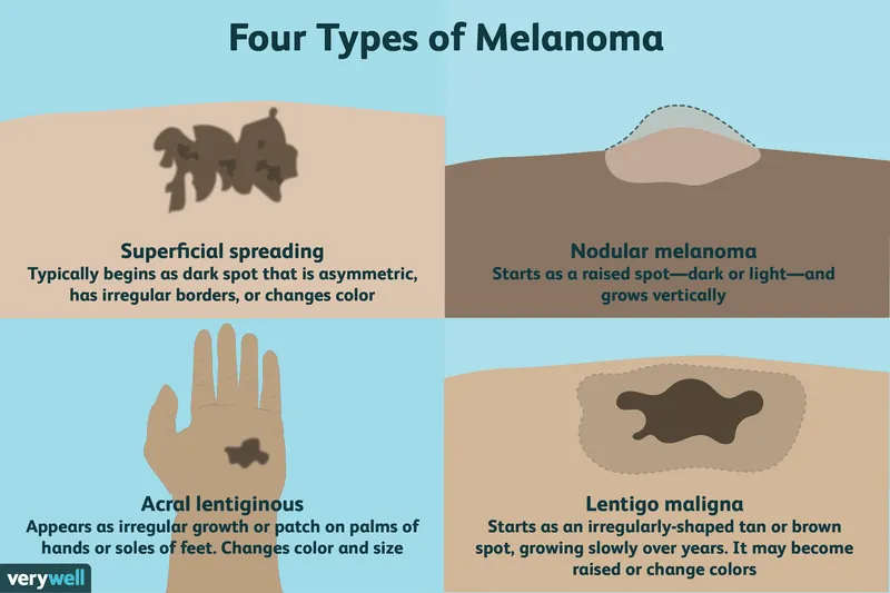 Four Types of Melanoma: Superficial, Nodular, Acral, Lentigo