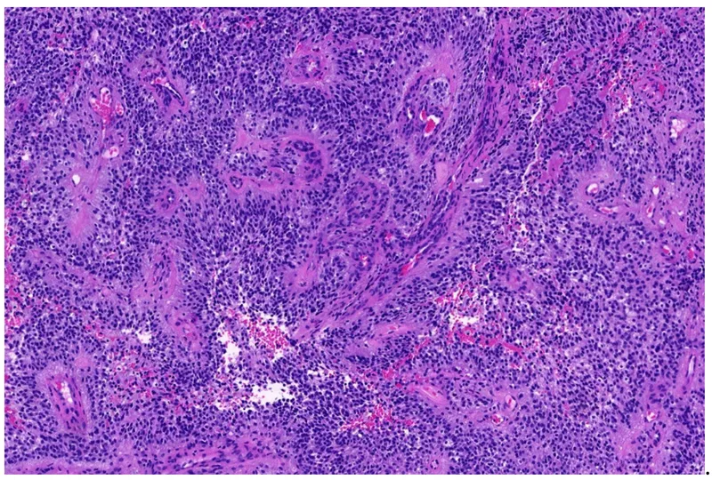 Merkel cell carcinoma with small blue cells