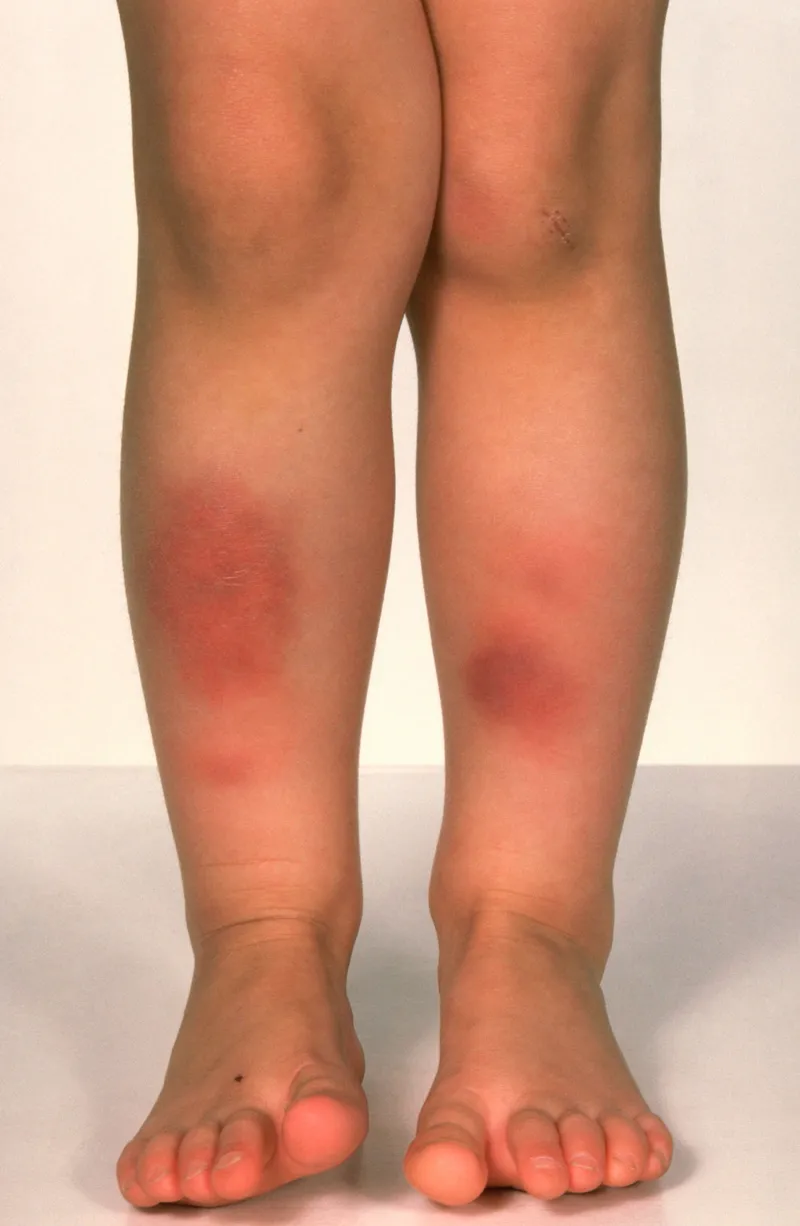 Erythema Nodosum on Shins