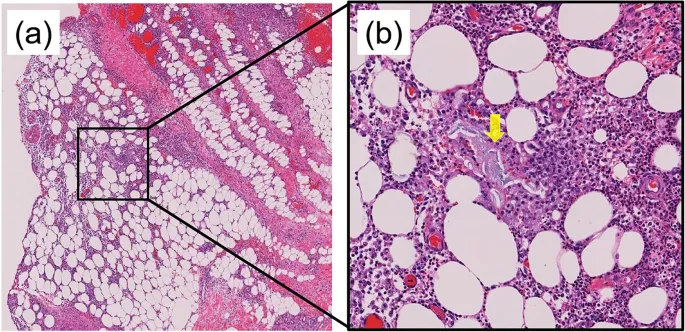 Pancreatic Panniculitis Histology