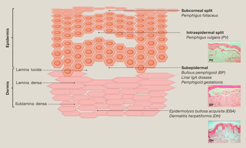 Skin layers and bullous disease split levels