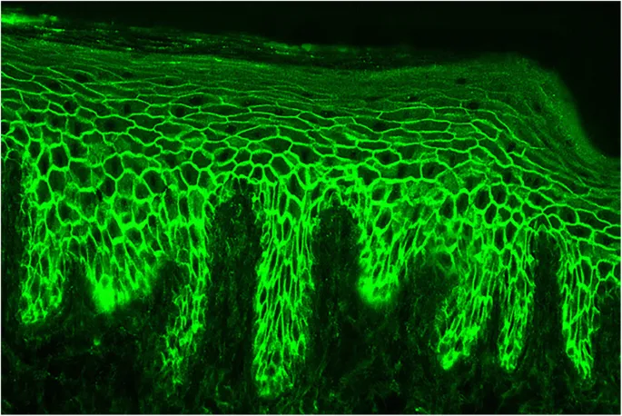 Pemphigus Vulgaris: Immunofluorescence, Net-like Pattern