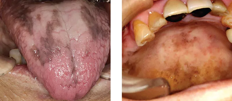 Oral hyperpigmentation in Addison's disease