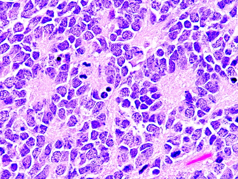 Neuroblastoma histology with Homer-Wright pseudorosettes