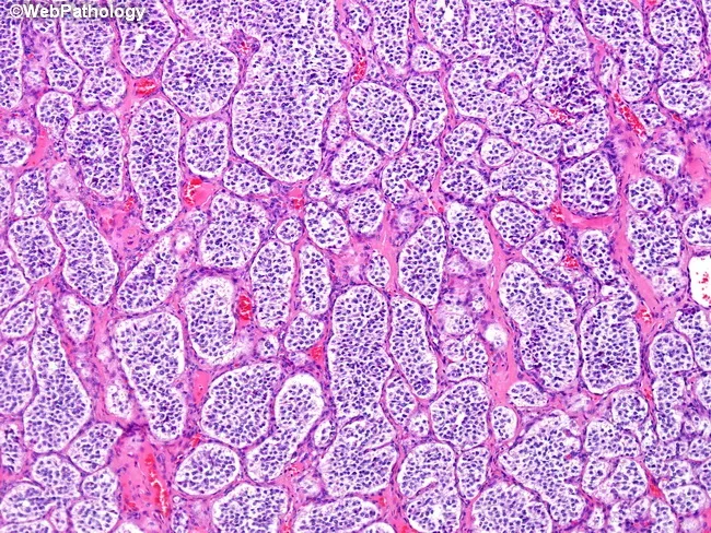 Pheochromocytoma Histopathology: Zellballen Pattern