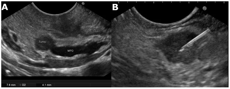 EUS of pancreatic tumor with biopsy needle