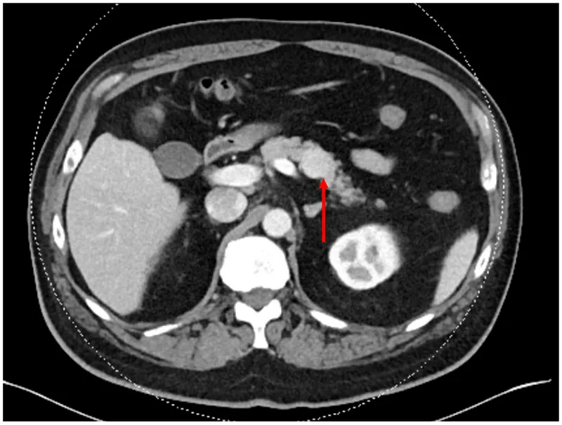 Pancreatic neuroendocrine tumor on CT