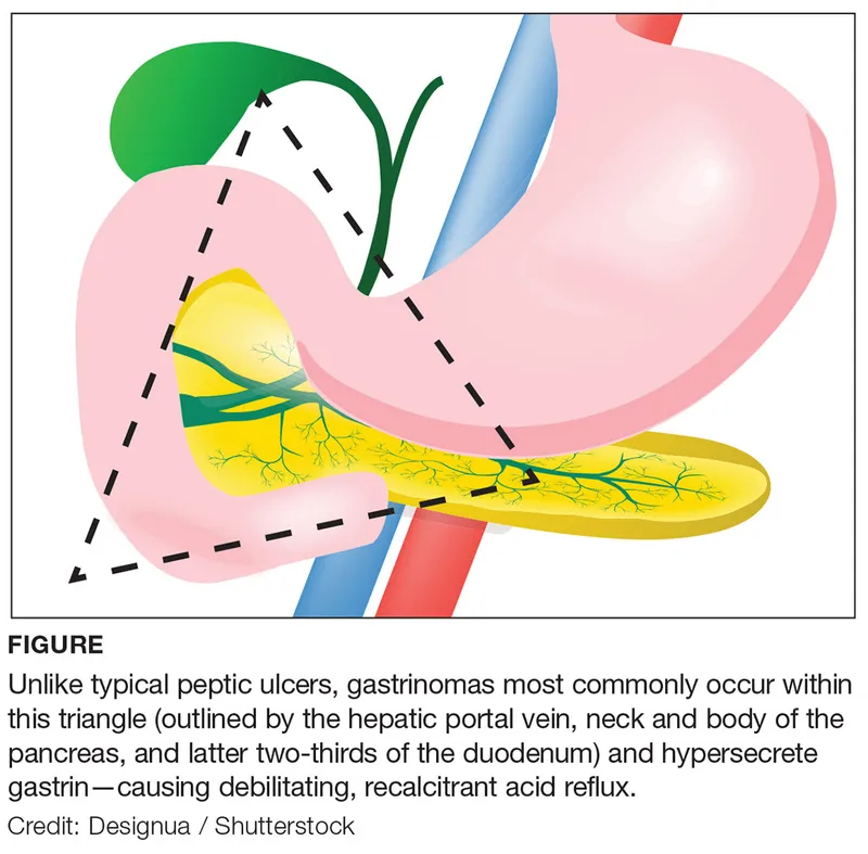 Gastrinoma Triangle Location