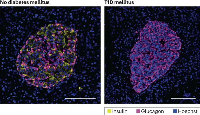Pancreatic islets: Normal vs. Type 1 Diabetes