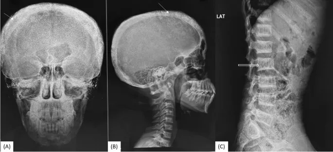 X-ray showing salt-and-pepper skull and rugger jersey spine