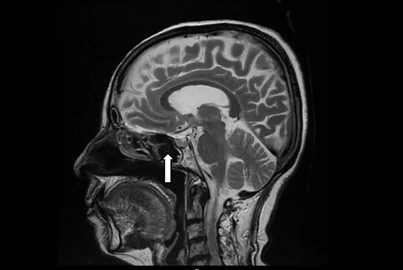 Sagittal MRI of normal pituitary gland