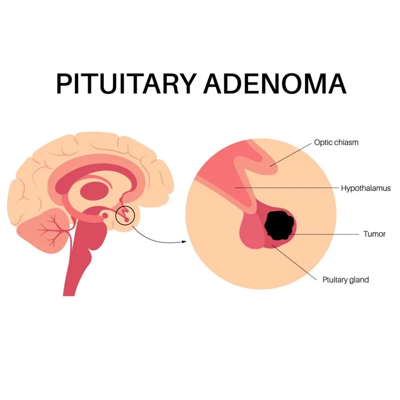 Pituitary Adenoma Diagram