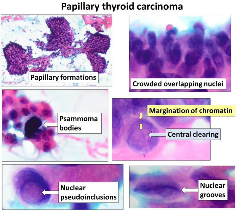 Papillary Thyroid Carcinoma: Orphan Annie Nuclei